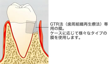 GTR法(組織誘導再生法)