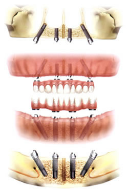 1日で仮歯が入る!最先端のインプラント治療