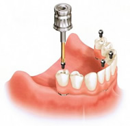 埋め込むインプラント数が最小で4本