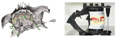 咬み合わせの前処置