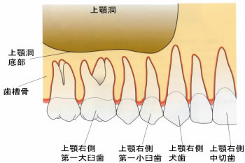 サイナスリフト（上顎洞底挙上術）