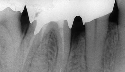 エムドゲイン（骨再生療法）～治療前～