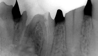 エムドゲイン（骨再生療法）～治療後～