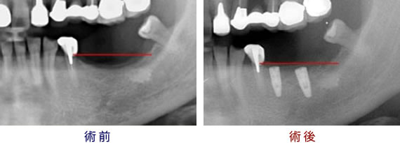 GBR法（骨再生誘導）