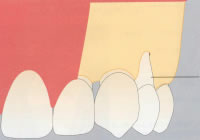 GBR法（骨再生誘導）