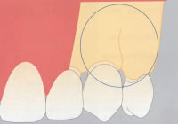 GBR法（骨再生誘導）