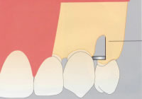 GBR法（骨再生誘導）