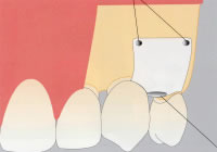 GBR法（骨再生誘導）