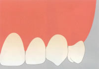 GBR法（骨再生誘導）