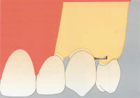 GBR法（骨再生誘導）