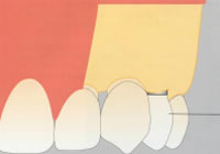 GBR法（骨再生誘導）