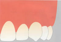 GBR法（骨再生誘導）