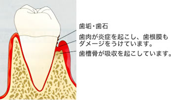 GTR法(組織誘導再生法)