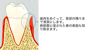 GTR法(組織誘導再生法)