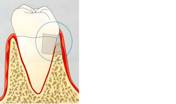 GTR法(組織誘導再生法)