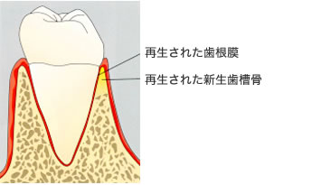 GTR法(組織誘導再生法)