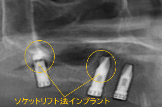 ソケットリフト